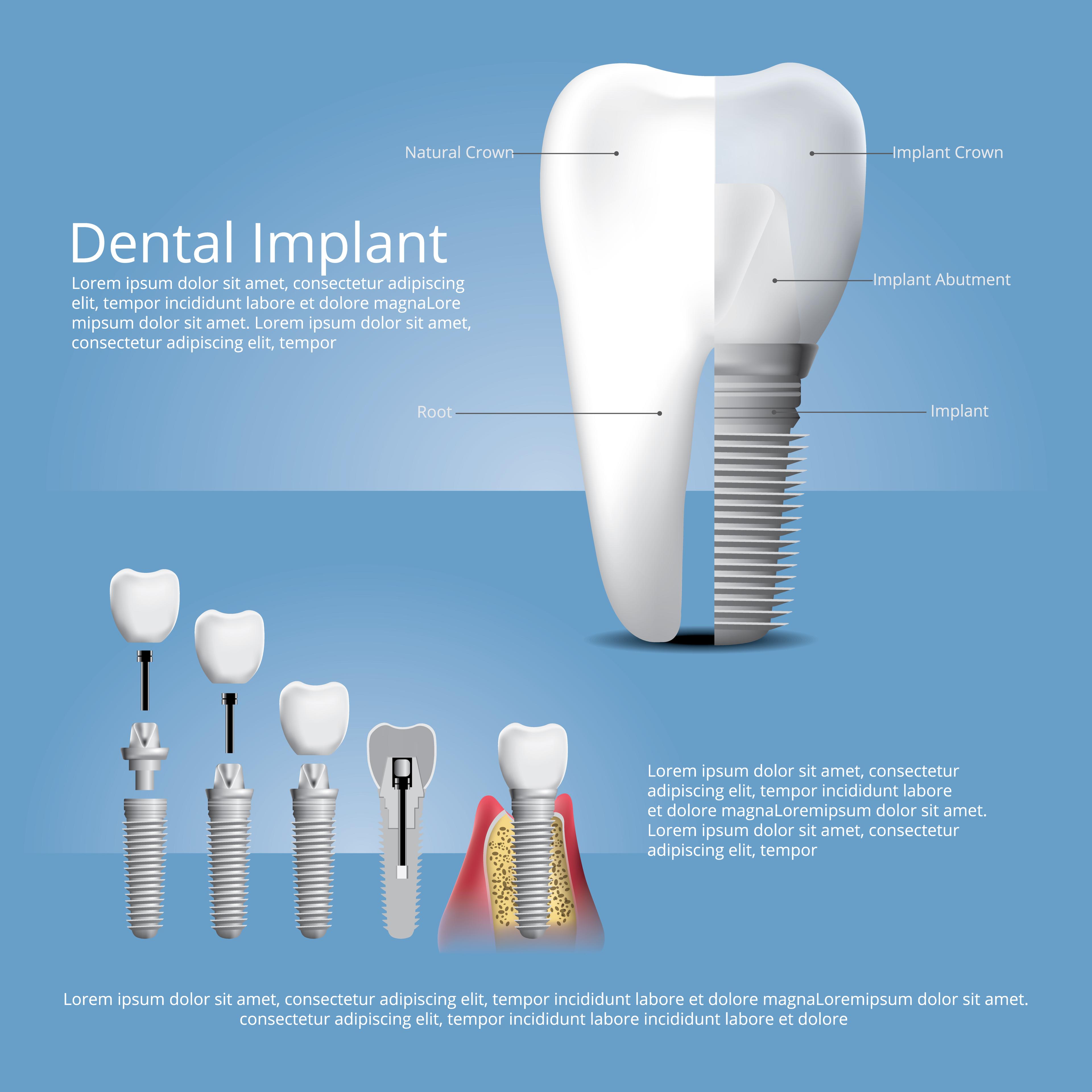 What to Expect During a Dental Implant Procedure
