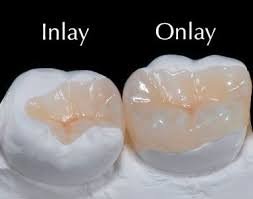 Onlays