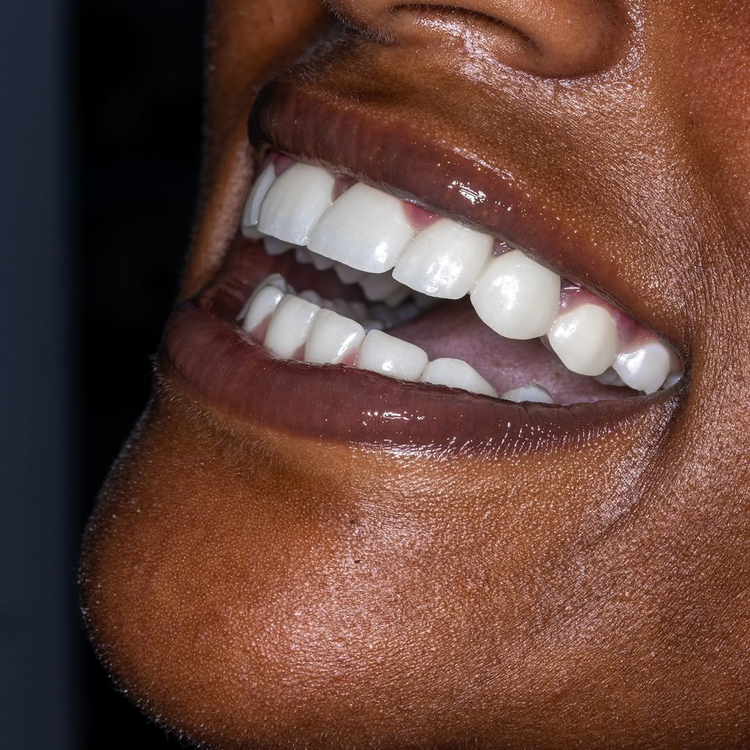 Smile Makeovers
