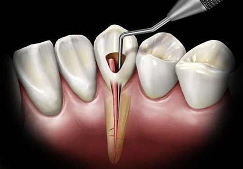 Emergency Root Canal Treatment