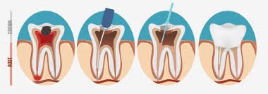 Multi-Canal Root Canal