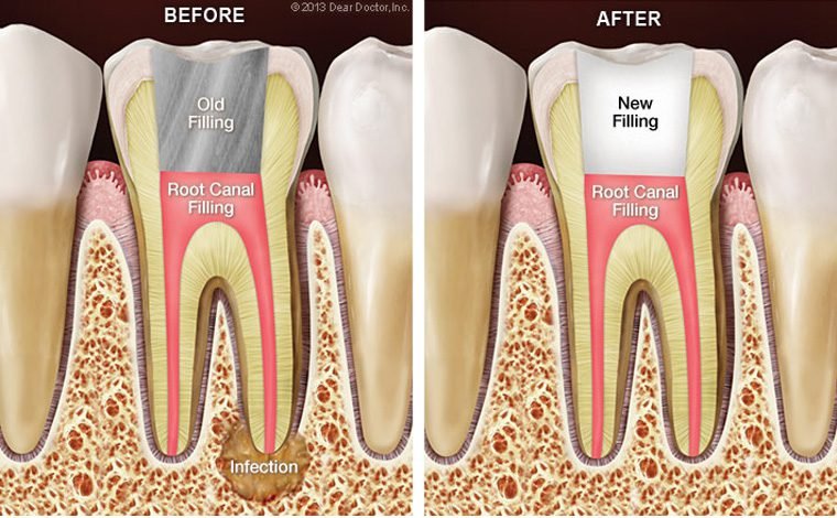 Root Canal Retreatment