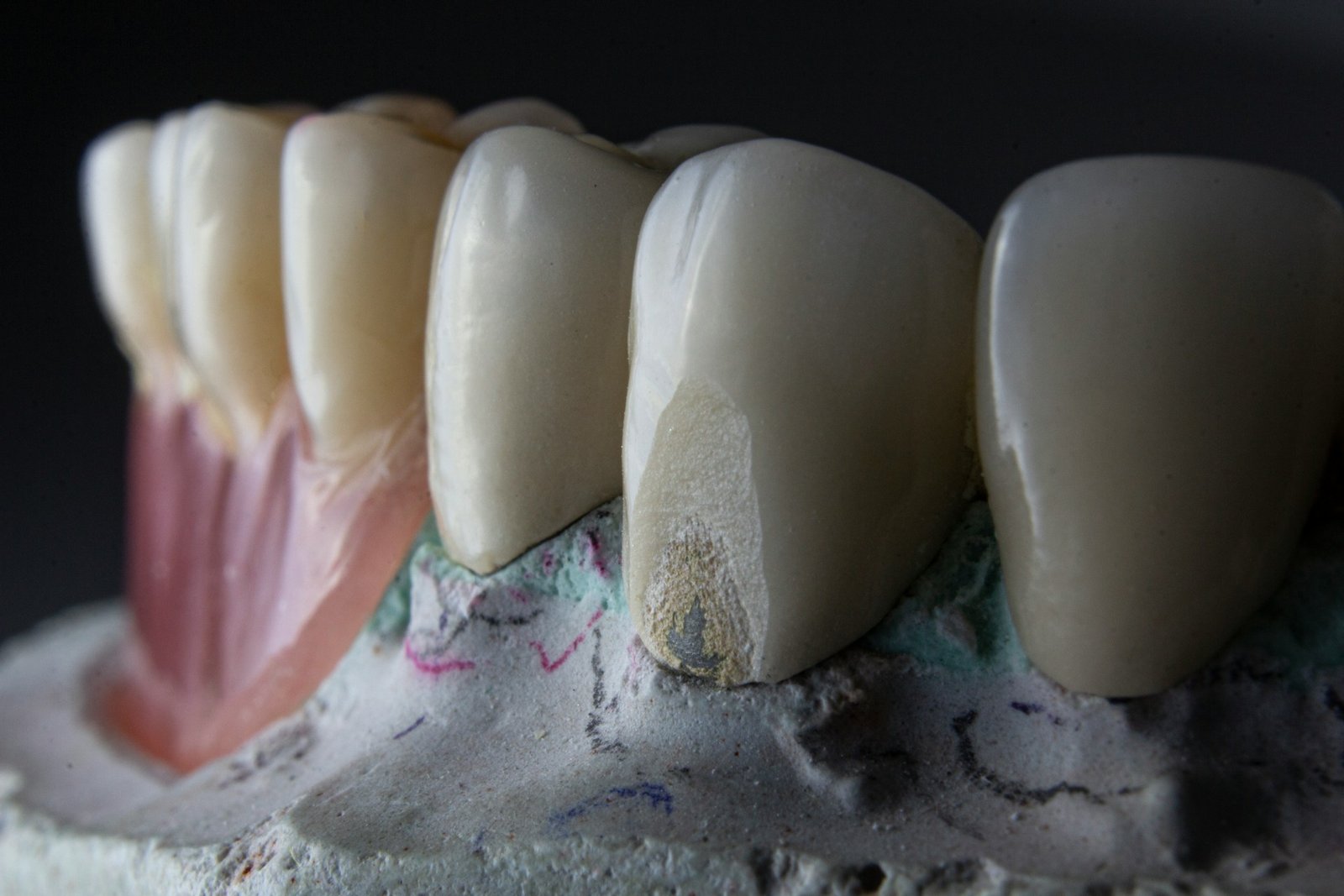 Chipped Tooth Repair