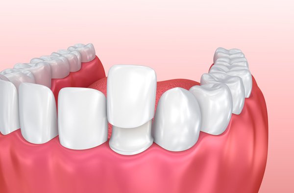 Dental Bonding