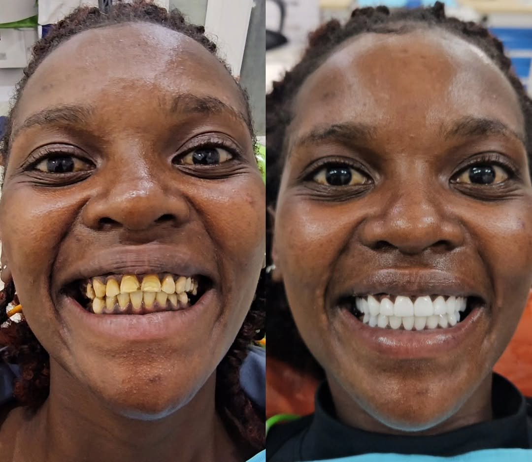 Fluoride Treatments