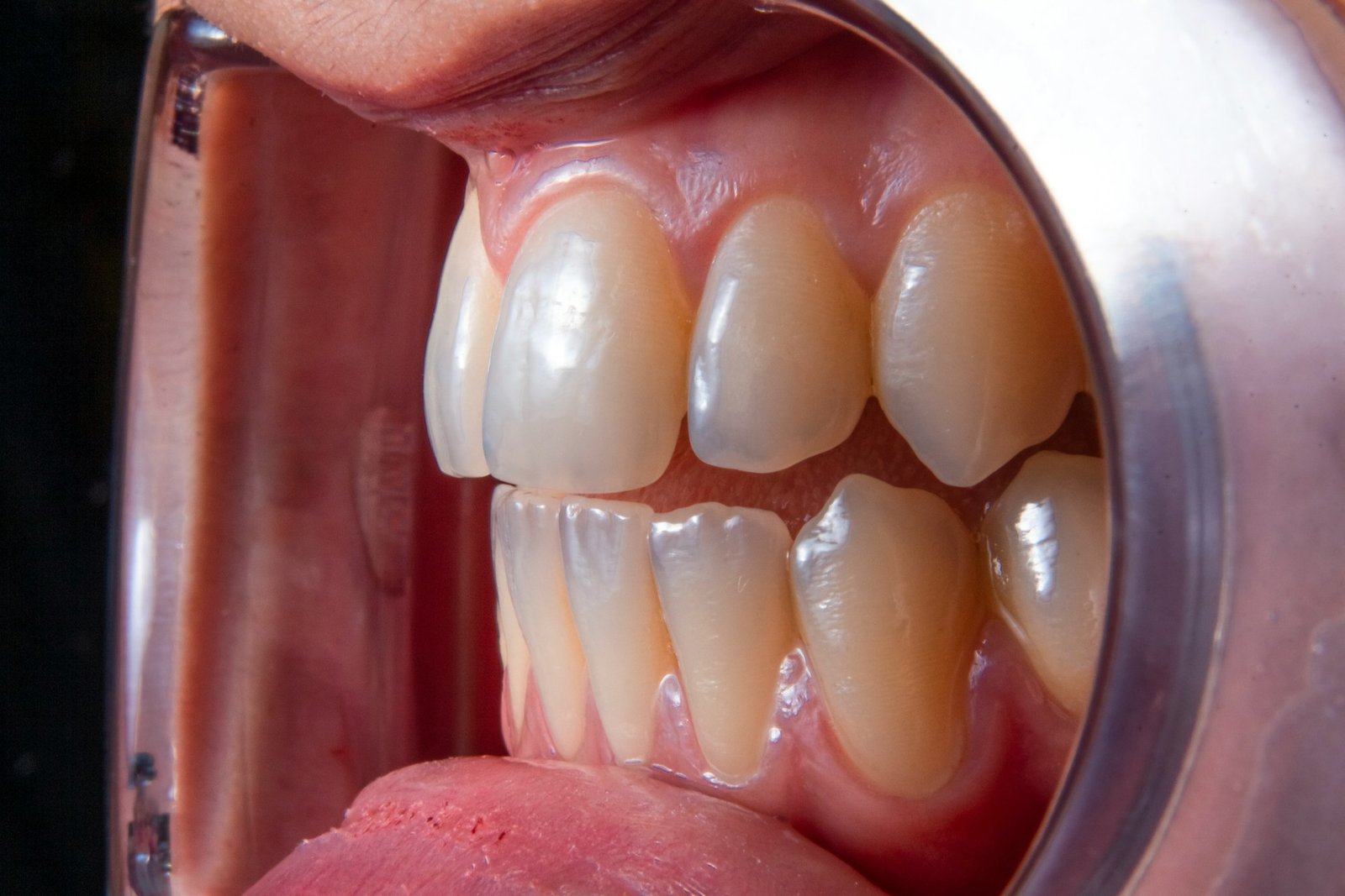 Minor Tooth Repairs
