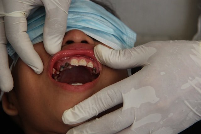 Tooth-Colored Fillings