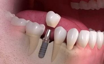 Dental Implant Placement