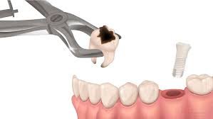 Immediate Implants