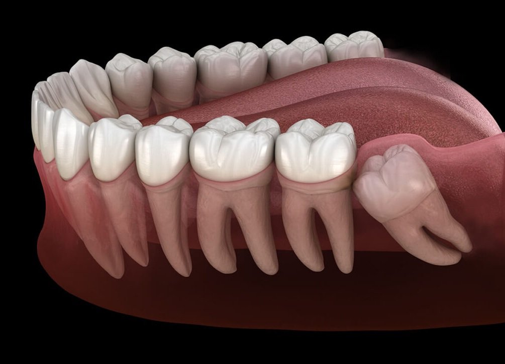 Impacted Tooth Removal