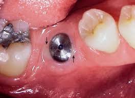 Implant Exposure Surgery