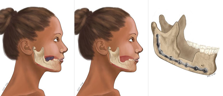 Jaw Reconstruction
