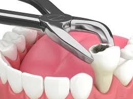 Simple Extractions