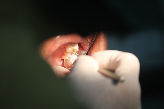 Wisdom Tooth Removal