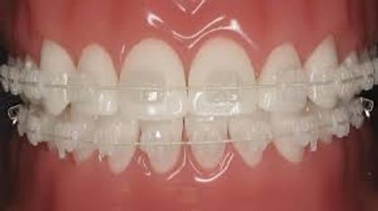 Ceramic Braces