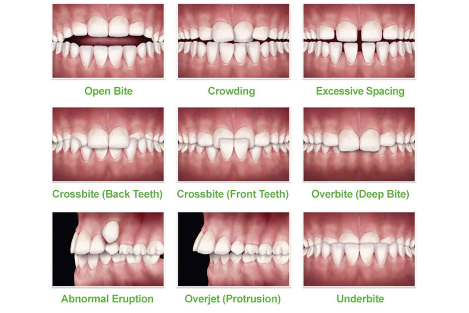 Interceptive Orthodontics